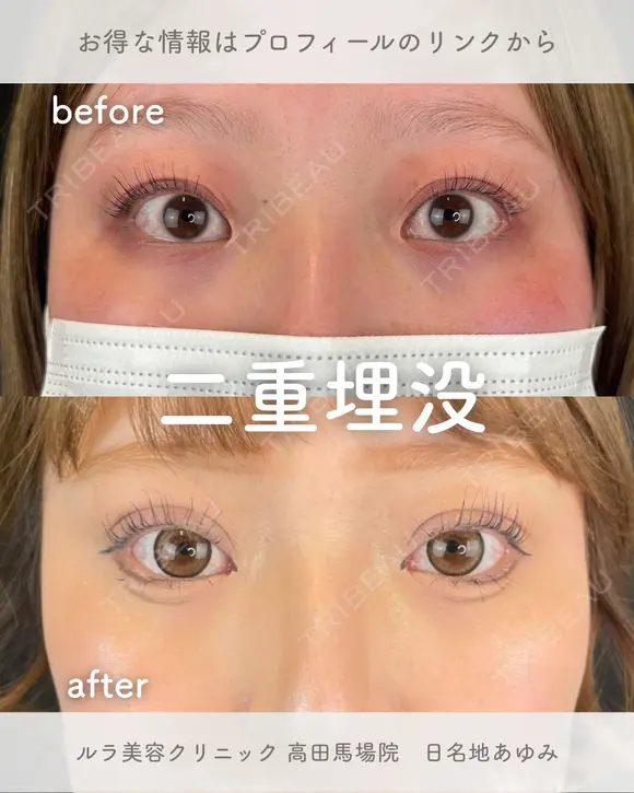 二重埋没法 after画像 メイン用