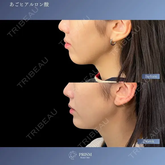 あごのバランスで変わる美しさ✨あごヒアルロン酸＆ボトックス 14日後 メイン用