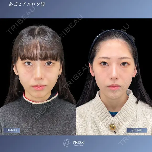 あごのバランスで変わる美しさ✨あごヒアルロン酸＆ボトックス 14日後 メイン用