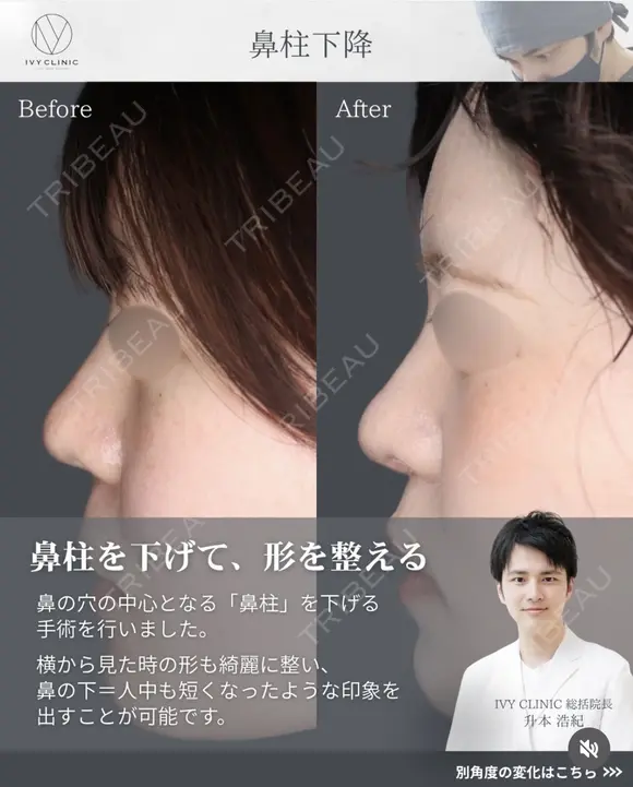鼻柱下降　 after画像 メイン用
