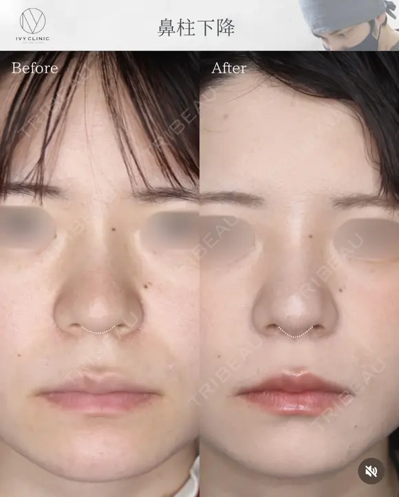 鼻柱下降 before画像 メイン用