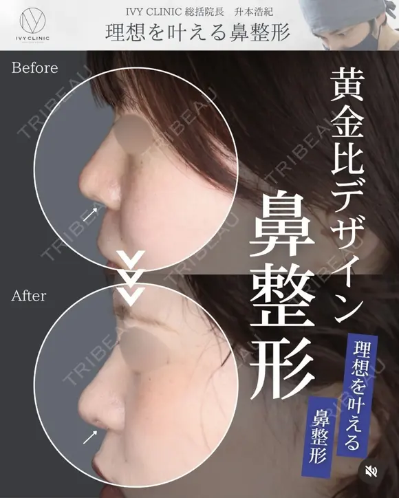 鼻柱下降 before画像 メイン用