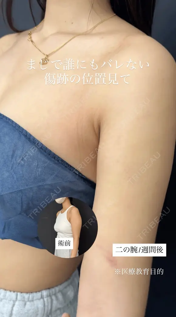 シークレット脂肪吸引二の腕 7日後 メイン用