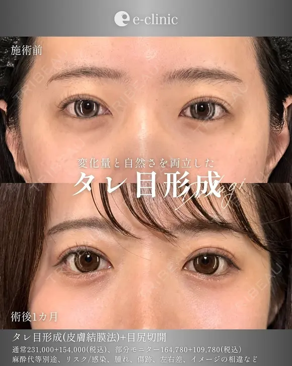タレ目・目尻切開 after画像 メイン用
