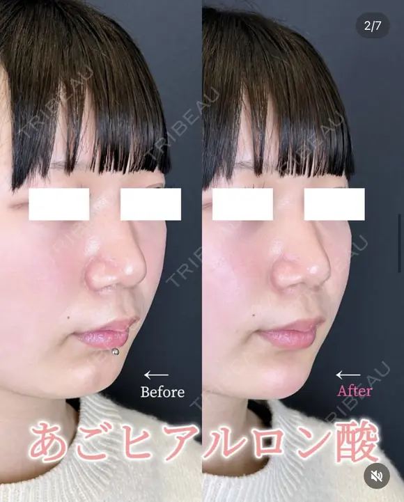 顎のヒアルロン酸 after画像 メイン用