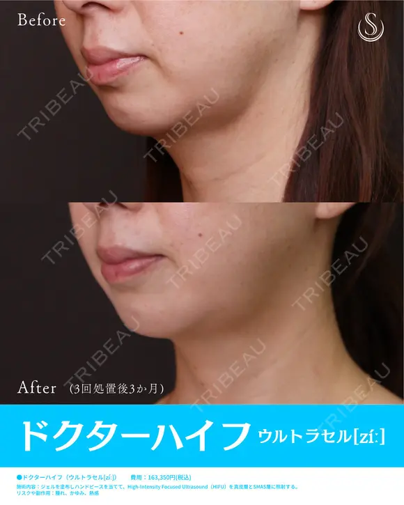 ドクターハイフウルトラセルZi(リニア)3回 after画像 メイン用