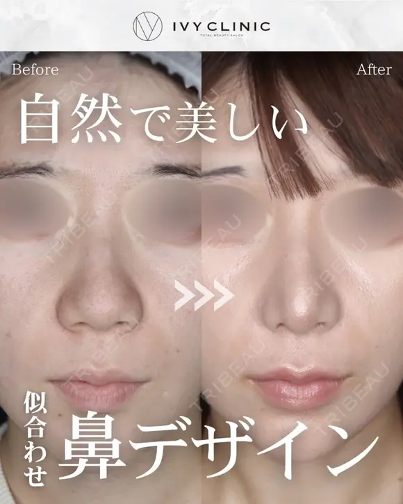 鼻尖形成　小鼻縮小　鼻柱下降 before画像 メイン用