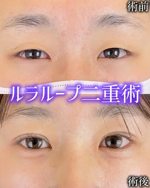 二重埋没 before画像 メイン用