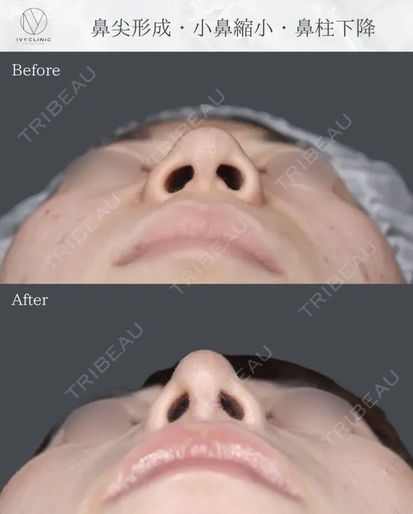 鼻尖形成　小鼻縮小　鼻柱下降 after画像 メイン用