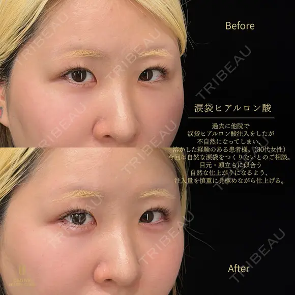 涙袋ヒアルロン酸 before画像 メイン用