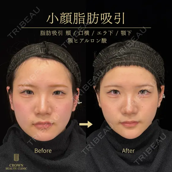 脂肪吸引注射（頬・口横・エラ下・顎下）・あごヒアルロン酸 31日後 メイン用