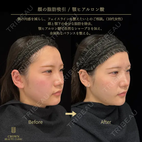 脂肪吸引注射（頬・口横・エラ下・顎下）・あごヒアルロン酸 before画像 メイン用