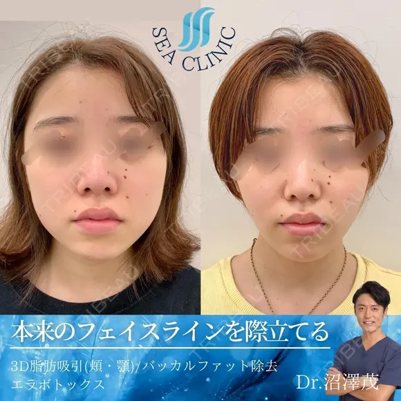 3D脂肪吸引（頬・顎）/バッカルファット除去/エラボトックス before画像 メイン用