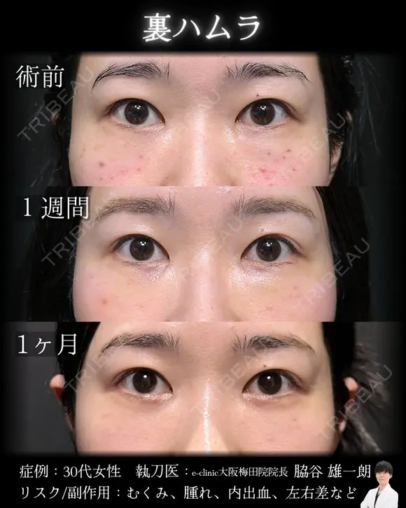 裏ハムラ 30日後 メイン用