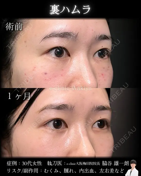 裏ハムラ 30日後 メイン用