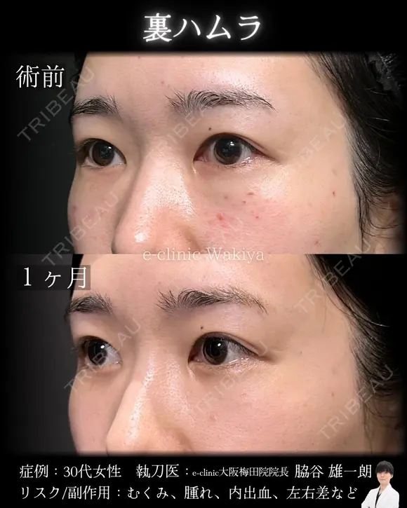 裏ハムラ 30日後 メイン用