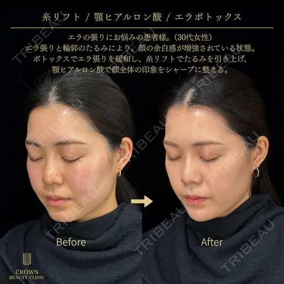 糸リフト・あごヒアルロン酸・エラボトックス before画像 メイン用