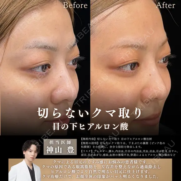 切らないクマ取り・目の下ヒアルロン酸 before画像 メイン用