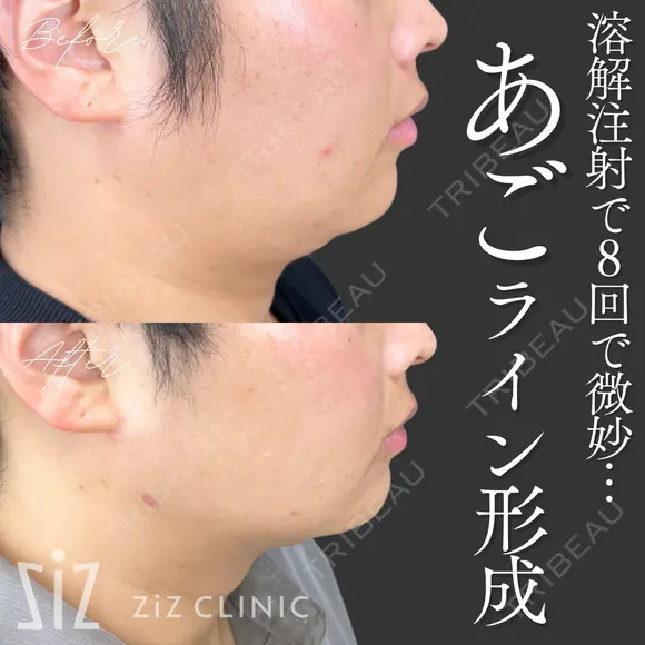 【ミニ脂肪吸引】溶解注射で8回で微妙… after画像 メイン用
