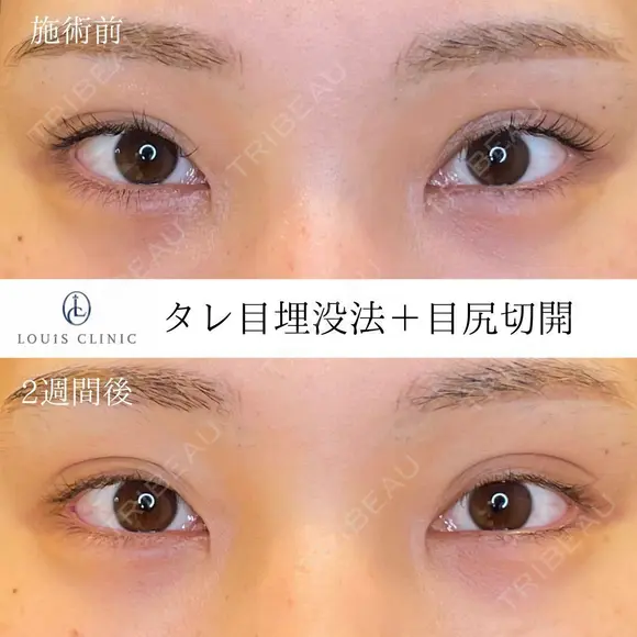 タレ目+目尻切開 14日後 メイン用