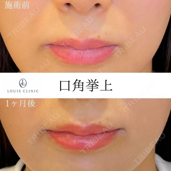 口角挙上 before画像 メイン用
