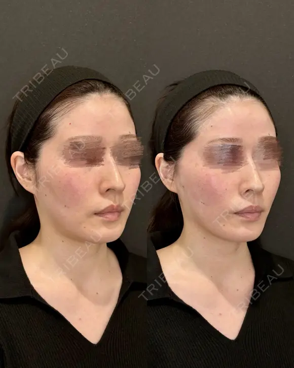 Olivia Lift before画像 メイン用