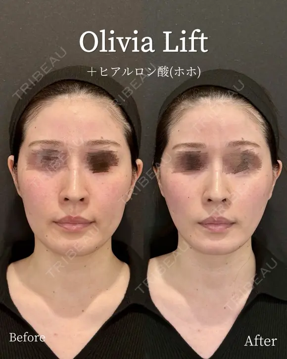 Olivia Lift after画像 メイン用