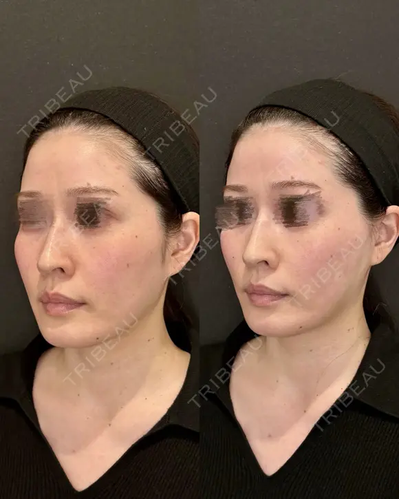 Olivia Lift after画像 メイン用