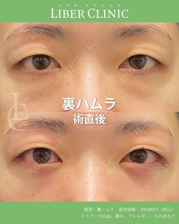 裏ハムラ術後1ヶ月 before画像 メイン用