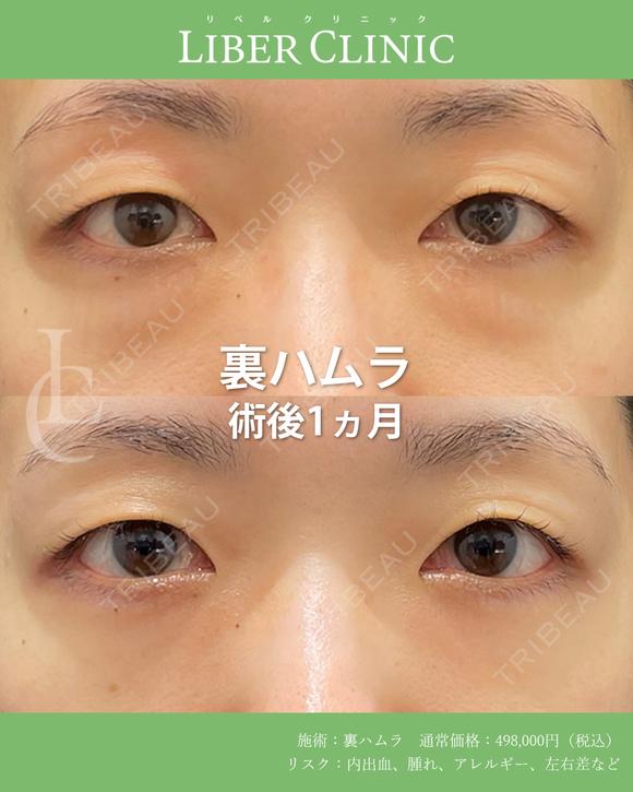 裏ハムラ術後1ヶ月 after画像 メイン用