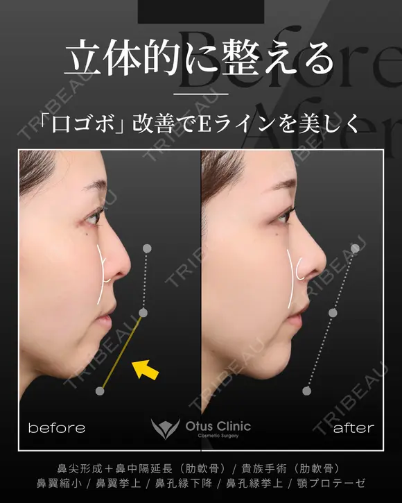 鼻尖形成＋鼻中隔延長（肋軟骨）・貴族手術（肋軟骨） 鼻翼縮小・鼻翼挙上・鼻孔縁下降・鼻孔縁挙上・顎プロテーゼ 90日後 メイン用
