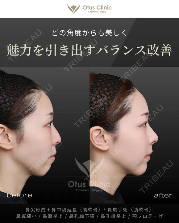 鼻尖形成＋鼻中隔延長（肋軟骨）・貴族手術（肋軟骨） 鼻翼縮小・鼻翼挙上・鼻孔縁下降・鼻孔縁挙上・顎プロテーゼ before画像 メイン用