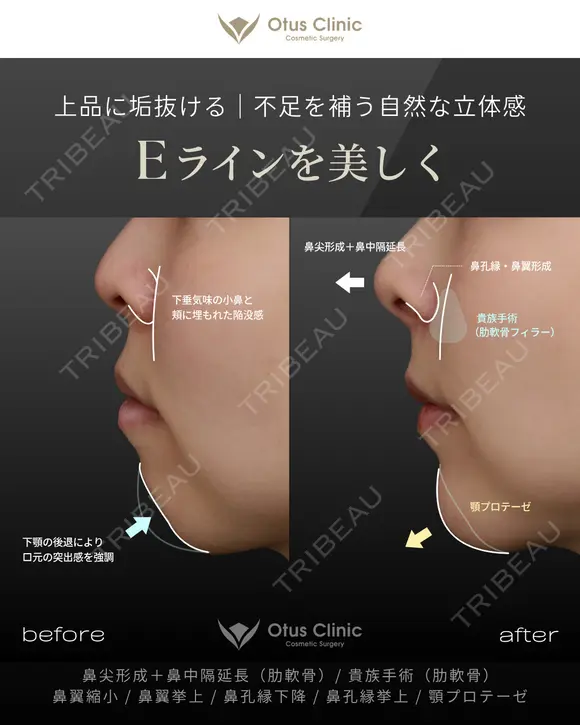 鼻尖形成＋鼻中隔延長（肋軟骨）・貴族手術（肋軟骨） 鼻翼縮小・鼻翼挙上・鼻孔縁下降・鼻孔縁挙上・顎プロテーゼ 90日後 メイン用