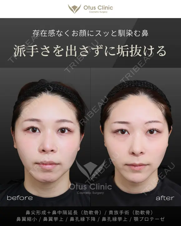 鼻尖形成＋鼻中隔延長（肋軟骨）・貴族手術（肋軟骨） 鼻翼縮小・鼻翼挙上・鼻孔縁下降・鼻孔縁挙上・顎プロテーゼ before画像 メイン用