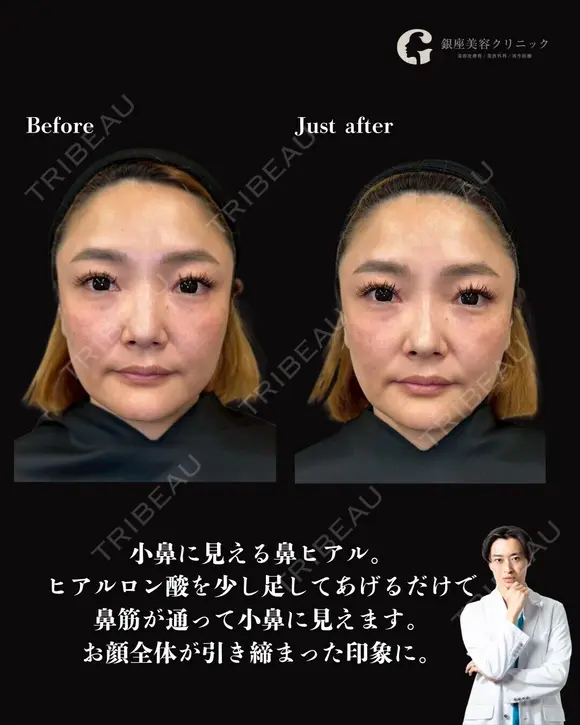 ヒアルロン酸 before画像 メイン用