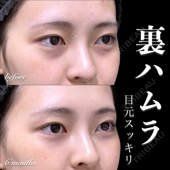 裏ハムラ 180日後 メイン用