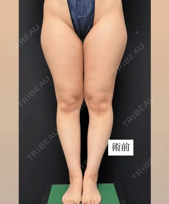 シークレット脂肪吸引脚まわり before画像 メイン用