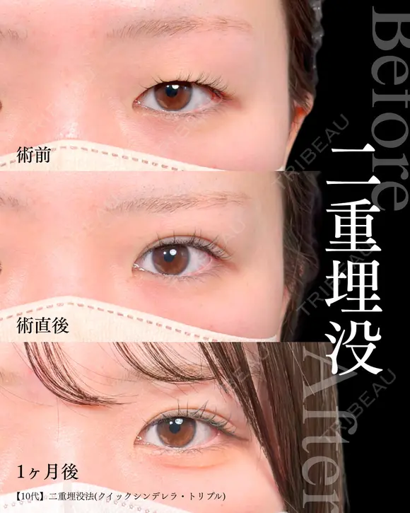 二重埋没法(クイックシンデレラ・トリプル) 30日後 メイン用