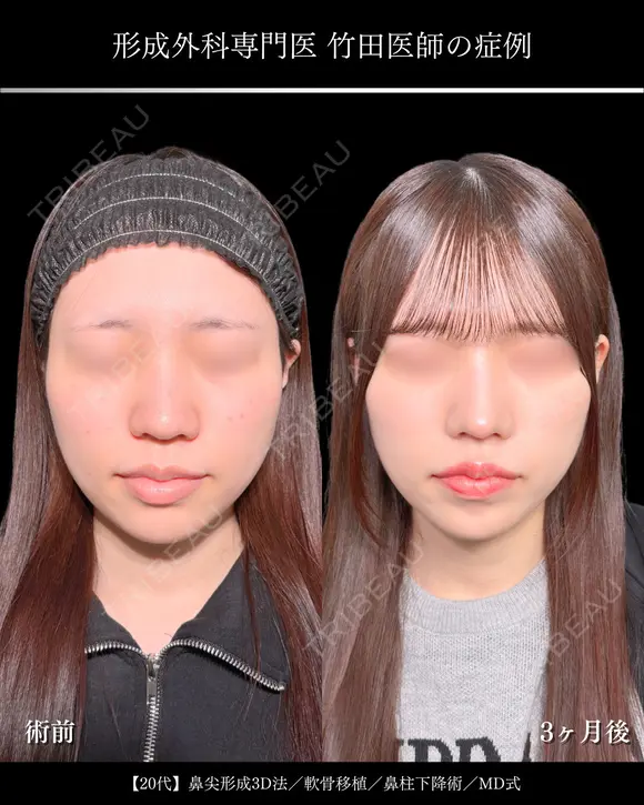 鼻尖形成3D法/軟骨移植/鼻柱下降術/MD式 before画像 メイン用