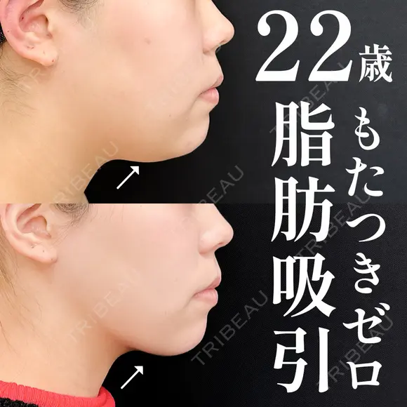 ベイザー併用アキーセル脂肪吸引＋糸リフト＋エンブレイスRF before画像 メイン用