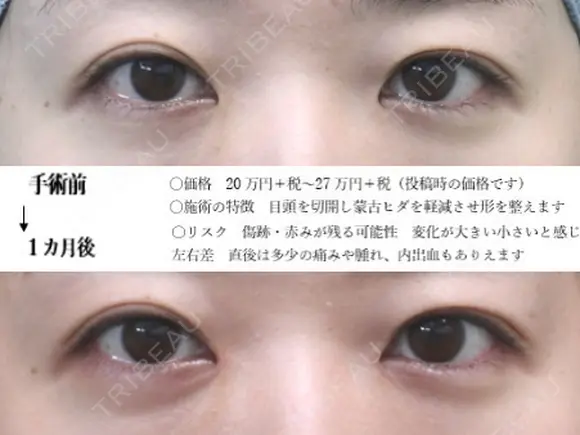 目頭切開法 before画像 メイン用