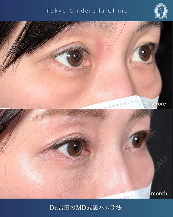 MD式裏ハムラ法 before画像 メイン用