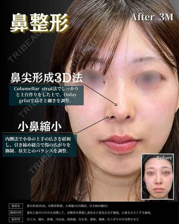 【鼻整形】鼻尖形成3D法＋耳介軟骨移植＋小鼻縮小 内側法・引き締め縫合 before画像 メイン用