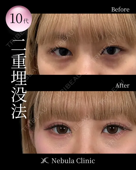 ⭐DR都築⭐二重埋没 before画像 メイン用