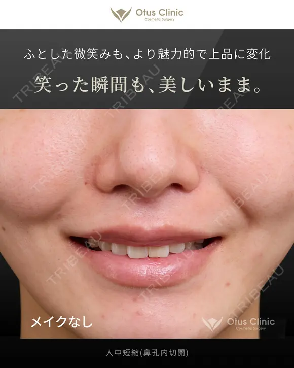 人中短縮（鼻孔内切開） 90日後 メイン用