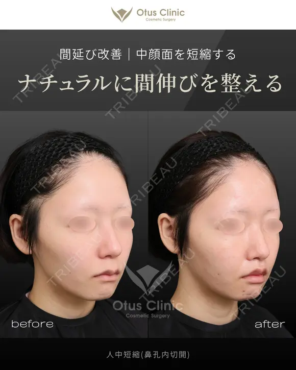 人中短縮（鼻孔内切開） before画像 メイン用