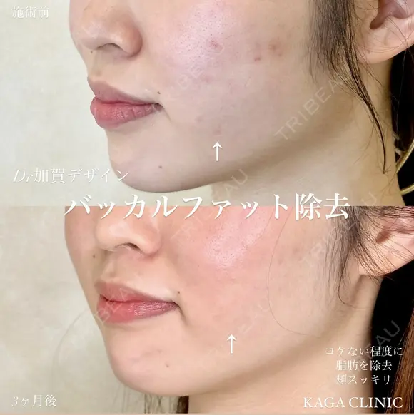 加賀デザイン×バッカルファット除去 after画像 メイン用