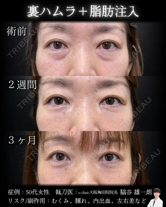 裏ハムラ・脂肪注入 90日後 メイン用