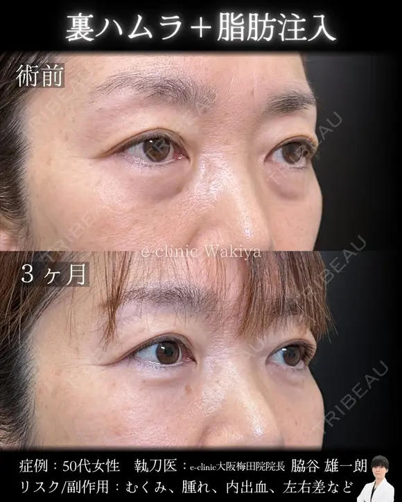 裏ハムラ・脂肪注入 90日後 メイン用