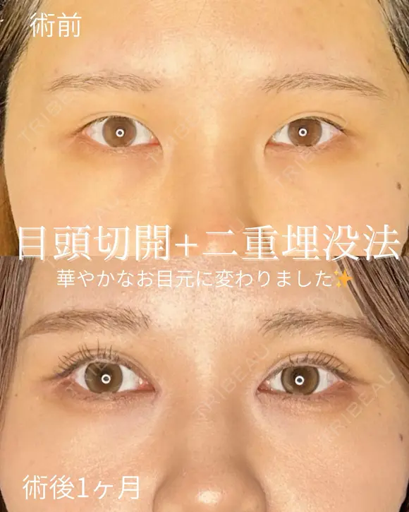目頭切開+二重埋没法 before画像 メイン用